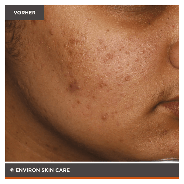 Environ Focus Care Clarity+ Botanical Infused Sebu - Spot Blemish Gel 10ml - Belrue