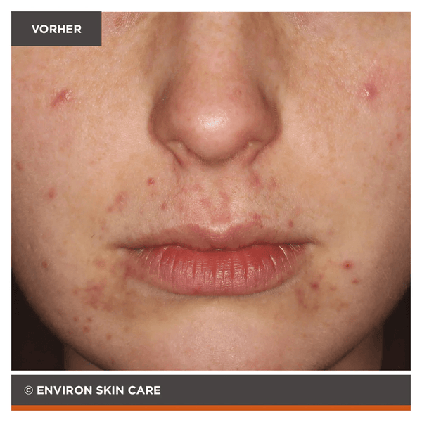 Environ Focus Care Clarity+ Botanical Infused Sebu - Tone Clarifier 100ml - Belrue